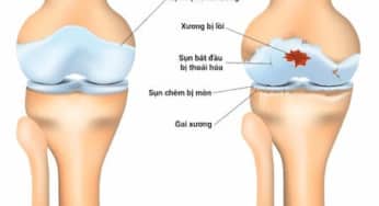 Kem trị viêm khớp giảm đau OTC: có đáng thử không