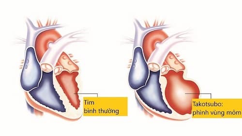 Khả năng phục hồi sau hội chứng trái tim tan vỡ (takotsubo)