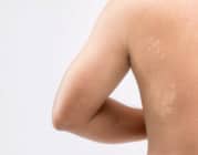 Lang ben bệnh lý ngoài da do nấm gây ra