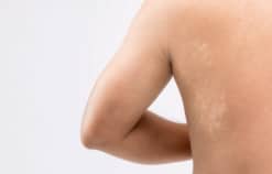 Lang ben bệnh lý ngoài da do nấm gây ra