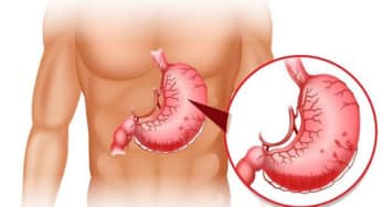 Liệt dạ dày và các yếu tố tăng nguy cơ