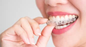 Lợi ích của chỉnh nha bạn nên biết