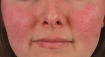 Triệu chứng chẩn đoán Lupus ban đỏ hệ thống