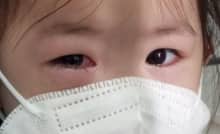 Một số lưu ý về bệnh đau mắt đỏ, cách phòng ngừa hiệu quả