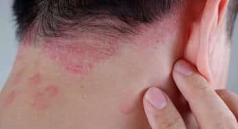 Mắc bệnh vẩy nến cảnh báo đường ruột có vấn đề