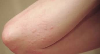 Mẩn ngứa thường xuyên đề phòng gan nhiễm mỡ