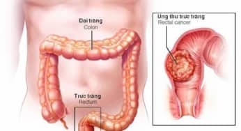 Mẹo ngăn ngừa ung thư đại trực tràng