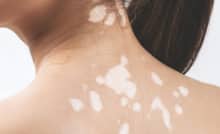 Mối liên hệ giữa bệnh bạch biến và các căn bệnh về đường ruột