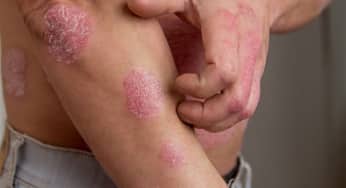 Mối liên hệ giữa hệ vi sinh đường ruột bệnh vảy nến, bệnh chàm