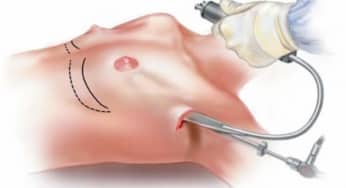 Một số phương pháp phẫu thuật thẩm mỹ thông thường trên cơ thể