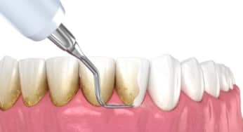 Mức độ nghiêm trọng mảng bám cao răng, cách phòng ngừa