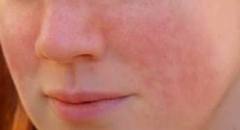 Mũi má ửng đỏ có thể là dấu hiệu bệnh gan nhiễm mỡ