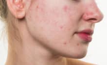 Mụn trứng cá đỏ dấu hiệu của SIBO
