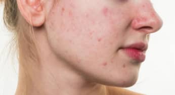 Mụn trứng cá đỏ dấu hiệu của SIBO