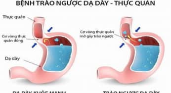 Nguyên nhân nào gây trào ngược axit vào ban đêm