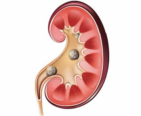 Nguyên nhân, triệu chứng bệnh sỏi thận