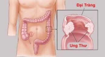 Những dấu hiệu sớm cảnh báo ung thư đại tràng cần nhận biết