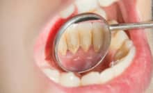 Những điều cần biết về cao răng