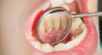 Những điều cần biết về cao răng