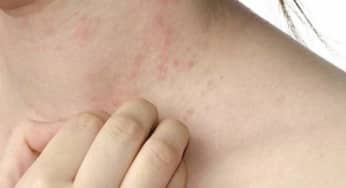 Những điều cần kiêng kỵ khi mắc bệnh sởi