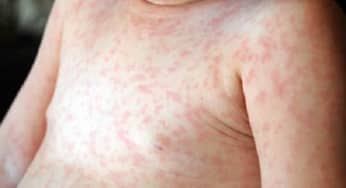 Phân biệt triệu chứng của bệnh sởi và sốt phát ban