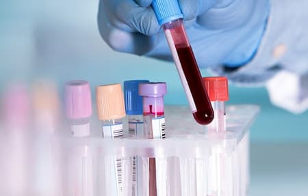 Phát hiện sớm 5 bệnh ung thư qua phương pháp xét nghiệm máu mới