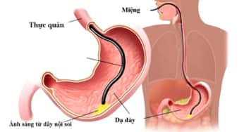 Phòng ung thư dạ dày có nên nội soi dạ dày mỗi năm 1 lần?