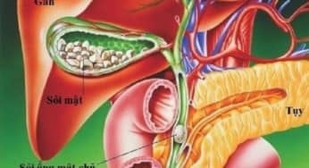 Phương pháp điều trị bệnh sỏi mật do SIBO