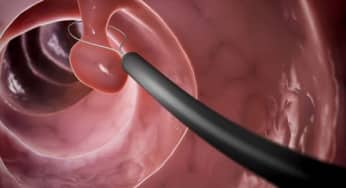 Nguyên nhân hình thành Polyp dạ dày, các yếu tố nguy cơ