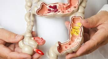 Polyp đại tràng nguy hiểm như thế nào?