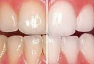 Răng ố vàng nguyên nhân do đâu, cách điều trị
