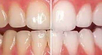 Răng ố vàng nguyên nhân do đâu, cách điều trị