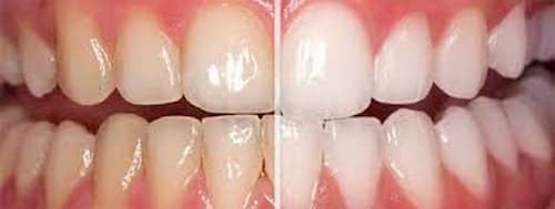 Răng ố vàng nguyên nhân do đâu, cách điều trị