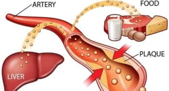 Điều trị rối loạn lipid máu theo phác đồ chuẩn của Bệnh viện Bạch Mai, Bộ Y tế