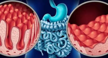 Ruột non: Một số rối loạn, bệnh lý phổ biến và phương pháp điều trị