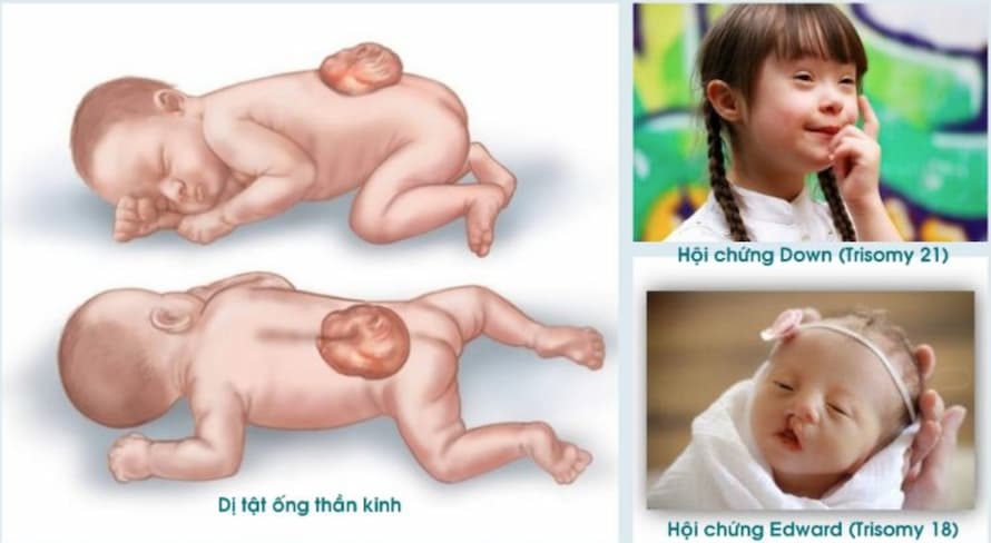 Sàng Lọc Dị Tật Thai Nhi: Đây là Tất cả Về Chẩn Đoán Di Truyền Tiền Sản