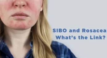 Mối liên hệ giữa SIBO và bệnh trứng cá đỏ