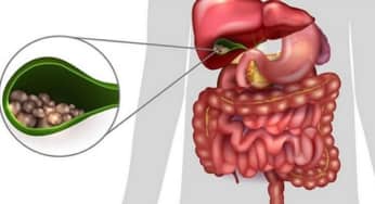 Sỏi mật triệu chứng của SIBO