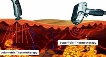 Sóng RF điều trị da: những câu hỏi bạn quan tâm khi thực hiện