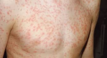 Nguyên nhân bệnh sốt phát ban, các triệu chứng