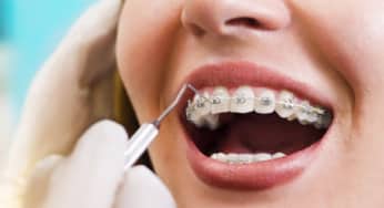 Tầm quan trọng của chỉnh nha đối với sức khỏe nha khoa