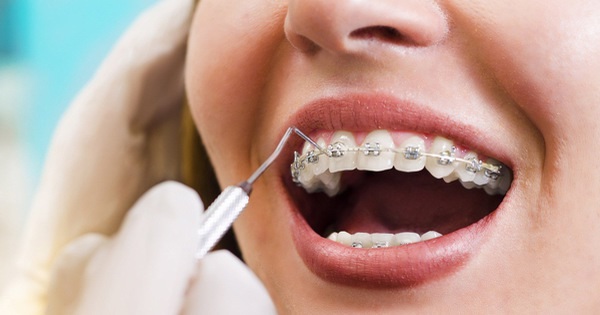 Tầm quan trọng của chỉnh răng đối với sức khỏe nha khoa