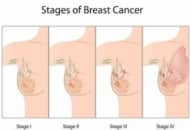 Trắc nghiệm: Dấu hiệu cảnh báo ung thư vú
