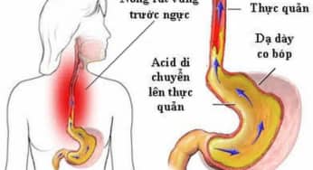 Trào ngược dạ dày nên ăn uống như thế nào?