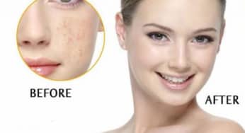 Trị nám da hiệu quả và đúng cách với Medi White