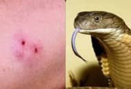Triệu chứng khi bị rắn độc cắn