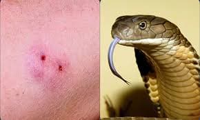 Triệu chứng khi bị rắn độc cắn