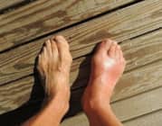 Tỷ lệ bệnh nhân mắc bệnh gout gia tăng do đâu