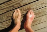 Tỷ lệ bệnh nhân mắc bệnh gout gia tăng do đâu