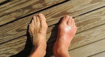 Tỷ lệ bệnh nhân mắc bệnh gout gia tăng do đâu